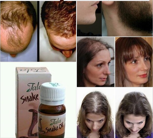 Tala Snake Oil 20Cc - REMOVES HAIR WITH SNAKE OIL FORMULA - 100% NATURAL FORMULA